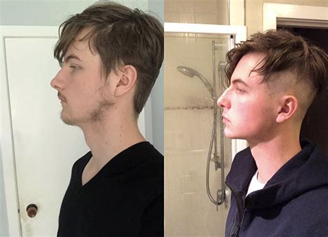 It got picked up by the r/looksmaxxing community and went viral. . Mewing before and after reddit